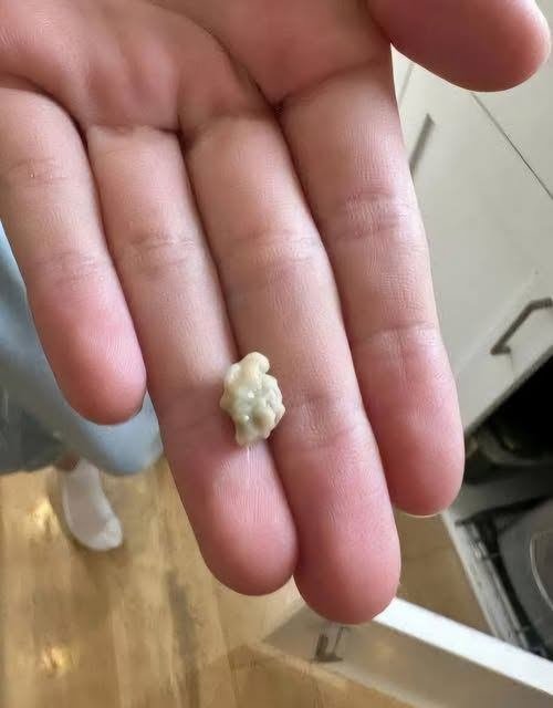 Here’s What You Need to Know About Tonsil Stones