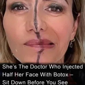 Doctor injects half her face with Botox to show dramatic results
