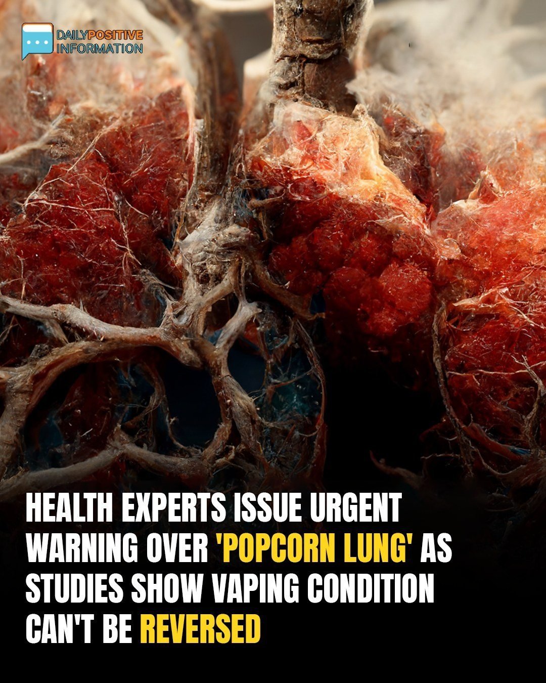 Urgent Alert: Vaping-Linked ‘Popcorn Lung’ Causes Lasting Harm, Experts Say
