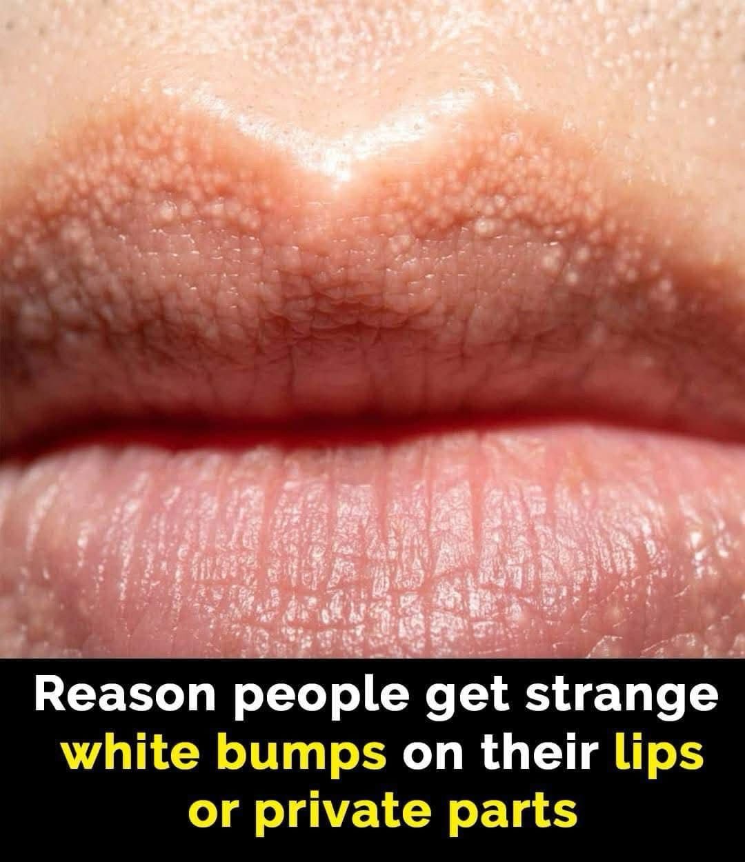 What Are Those White Bumps That Can Appear On Your Private Parts and What Causes Them?