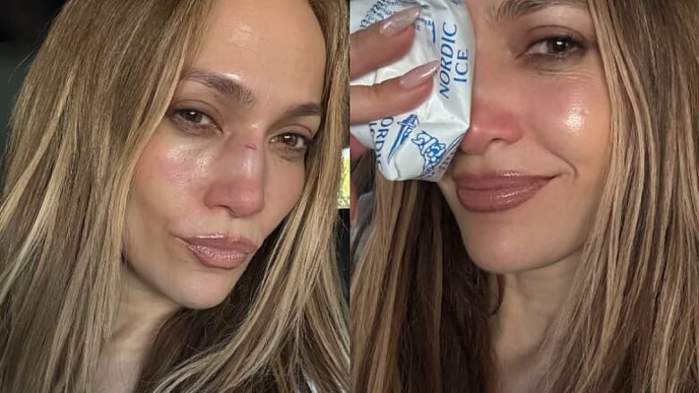 Jennifer Lopez suffers accident while preparing for a performance, shows bruises on her face